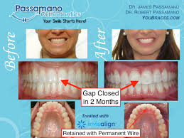 Gap teeth, called diastema, are extremely common. Invisalign Express 2 Months Only To Close Front Gap Passamano Orthodontics