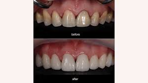 However, there are situations where insurance companies will cover part of the cost for veneers and bonding. Composite Veneers Pros Cons Procedure Cost And Alternatives