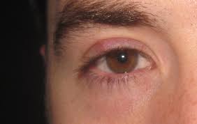Two classmates keep flipping their eyelids inside out. Steps A Denver Eyelid Surgeon Does To Remove A Stye Or Chalazion