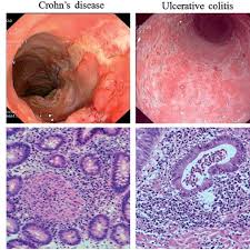 Both conditions can affect any part of the gi tract, but ulcerative colitis only involves the colon and rectum. Endoscopic And Histological Features Of Crohn S Disease Cd And Download Scientific Diagram
