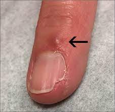 fingernail deformity mdedge family