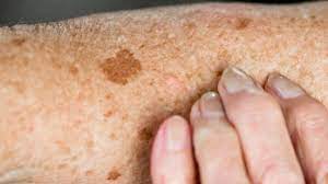 age spots causes symptoms and diagnosis