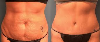 michigan tummy tuck abdominoplasty