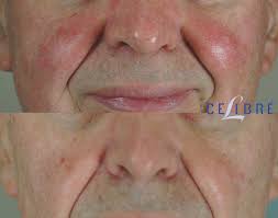 rosacea treatment before and after pictures