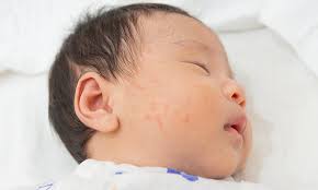 baby heat rash symptoms prevention
