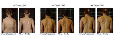 scoliosis treatment for a 20 year old