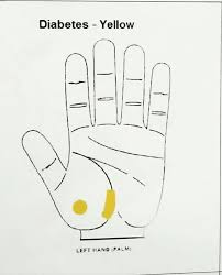For Diabetes On Left Hand Palm Acupressure Treatment