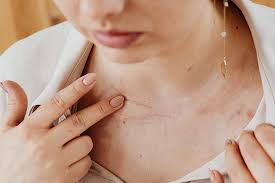scars during healing