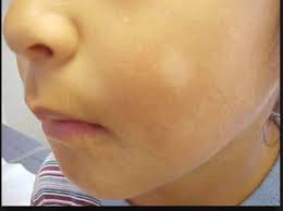 Pityriasis alba is a common, benign skin disorder occurring predominantly in children and adolescents. Pityriasis Alba Is A Skin Abhishek Homeopathic Agency Facebook