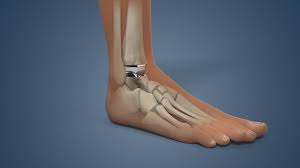 Ankle Replacement Surgery: How It Works, Recovery Time | HSS