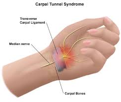open carpal tunnel release st george