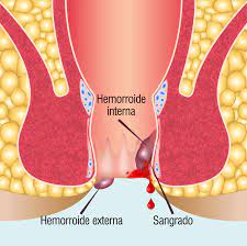 La trombosis hemorroidal se desarrolla en personas que ya tienen hemorroides y se caracteriza por la formación de coágulos en la región afectada. Hemorroides Que Son Sintomas Y Tratamientos