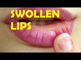swollen lips after kissing