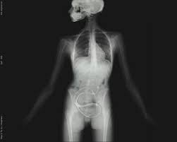 Does an X Ray Image Show a Snake InsIde a Woman s Body