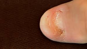 toenail problems causes symptoms and