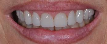 A missing tooth or a gap between your teeth can can now be easily fixed for a fraction of the cost of permanent dental veneers with a not so new diy veneer. Veneers Bridgeport And Shelton Ct Dentist Dejesus Dental Group