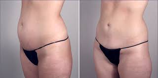 Tummy Tuck in Paramus, New Jersey | Parker Center for Plastic Surgery