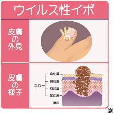 ウイルス性イボ(尋常性疣贅)とは(治療など) | 新宿駅前クリニック皮膚科