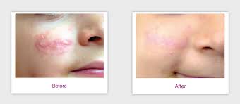 v beam pulsed dye laser lakes dermatology