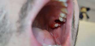 blood clot after tooth extraction 8 of