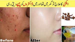 remove acne overnight pimple