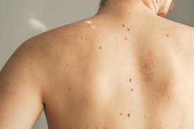 skin cancer angeline yong dermatology