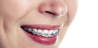 An overbite is a common dental condition that occurs when your teeth do not match up properly. Which Color Of Braces Should You Get Proprofs Quiz