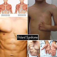 Deutlich sichtbar wird diese brustfehlbildung. Lil Bone Peep V Twitter Poland Syndrome Disorder W Unilat Missing Underdeveloped Muscles Resulting In Abnormalities Affects Pec Major Most Commonly W Assoc Rib Nipple Breast Abnormalities Also Can Affect Shoulder Arm Commonly The