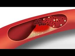 Managing High Cholesterol Symptoms Causes Treatment