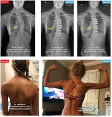 scoliosis surgery before and after