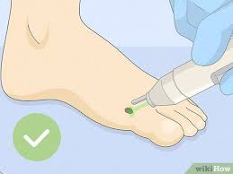 how to freeze a wart