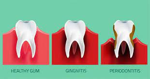 herbal remes of periodontal gum