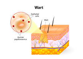 warts boils cysts fldscc