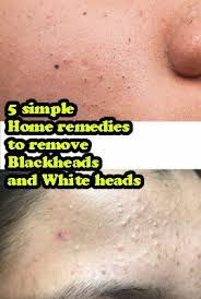 They are basically a type of acne and pimple. 5 Simple Home Remedies To Remove Black And White Heads Reenu S Zone Pimples On Face Blackheads On Nose White Heads On Nose