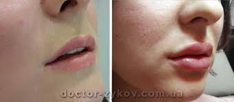 lip augmentation with fillers in warsaw