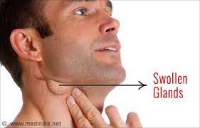 swollen glands symptom evaluation