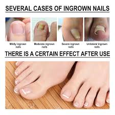 nail toenail repair treatment nail