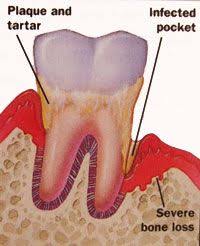 70% bone loss is quite a bit. How To Stop Bone Loss In Teeth Naturally Bone Loss Dental Teeth