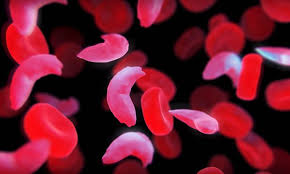 Resultado de imagem para anemia falciforme