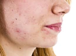 Most of the doctors have evaluated the common cause of hirsutism in women is polycystic ovarian syndrome (pcos) which we will discuss in detail further. Excessive Or Unwanted Hair In Women Causes And Natural Treatments