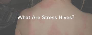Stress/anxiety hives are the worst. What Are Stress Hives Mellowed What Is Stress Hives Causes Stress