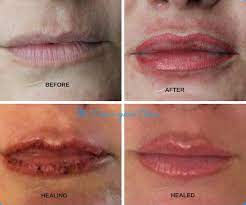 permanent tattooed lip colour for