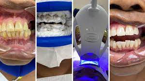 the zoom teeth whitening experience