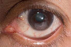 what is corneal scarring