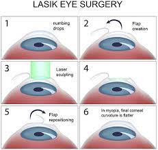 Eyesight tends to deteriorate as we get older; Lasik Eye Surgery Top Eye Specialist Best Rated Nyc Ophthalmologist
