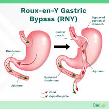 gastric sleeve after gastric byp