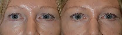 Now a £1700 new treatment promises to use ultrasound, fillers and botox to cure dark circles and sagging skin. Filler Vs Lower Blepharoplasty For Dark Circles And Under Eye Bags