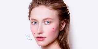 how to treat your acne rosacea breakouts