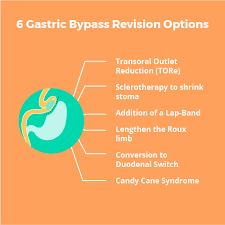 gastric byp revision surgery 6