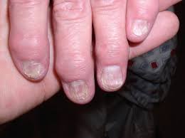 treatment outline for common nail
